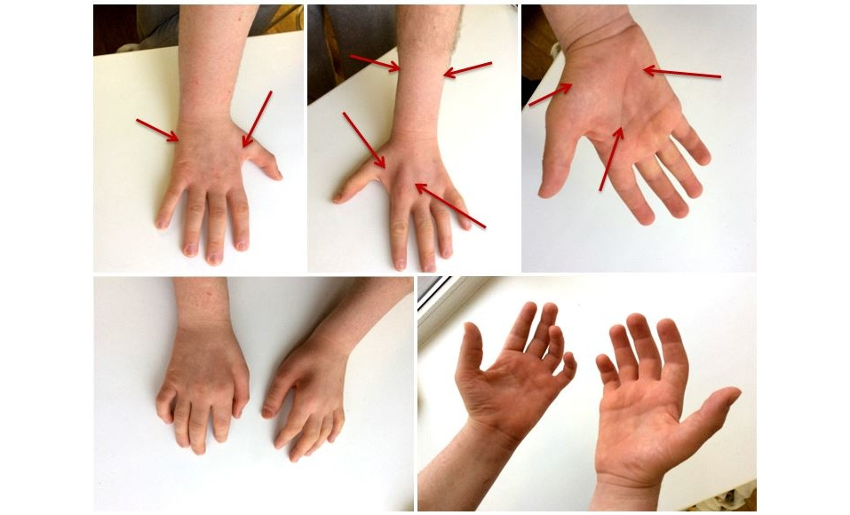 Синдром лапки. Синдром вегетативно-сенсорной полиневропатии верхних конечностей. Нейропатия локтевого нерва ЛФК. Гимнастика для рук при полинейропатии верхних конечностей. Упражнения для кистей рук при полинейропатии.
